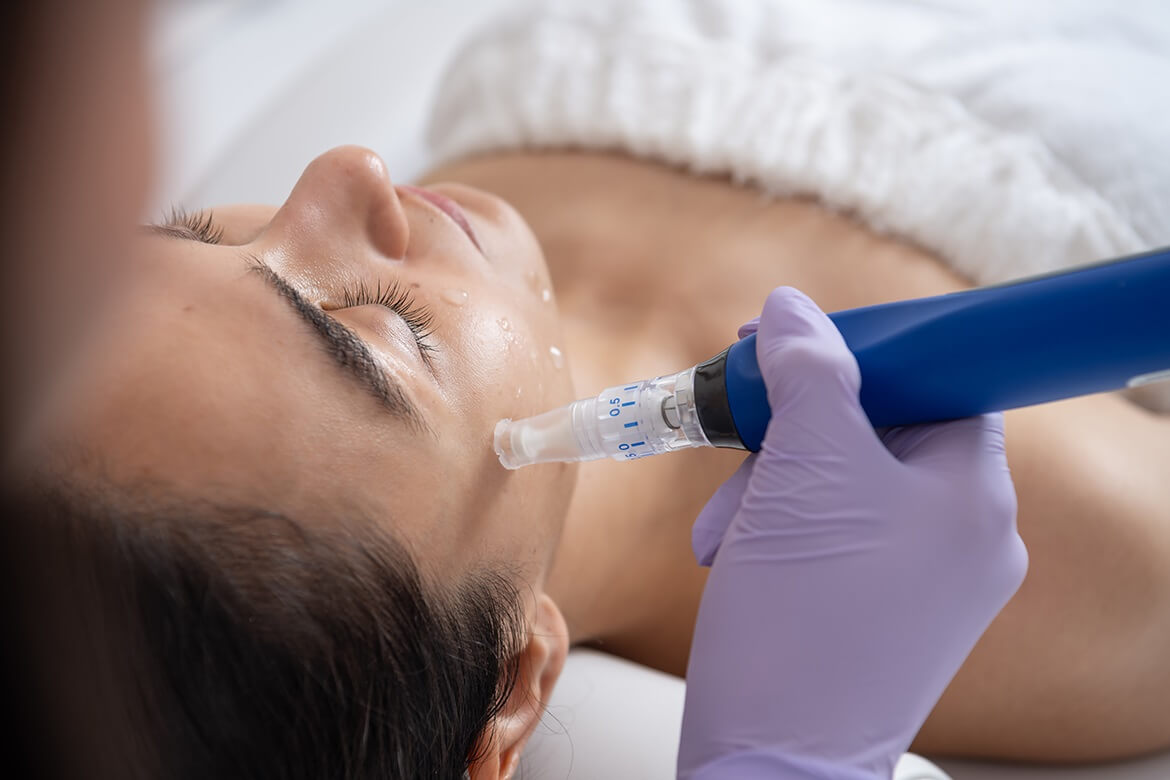 microneedling-treatment