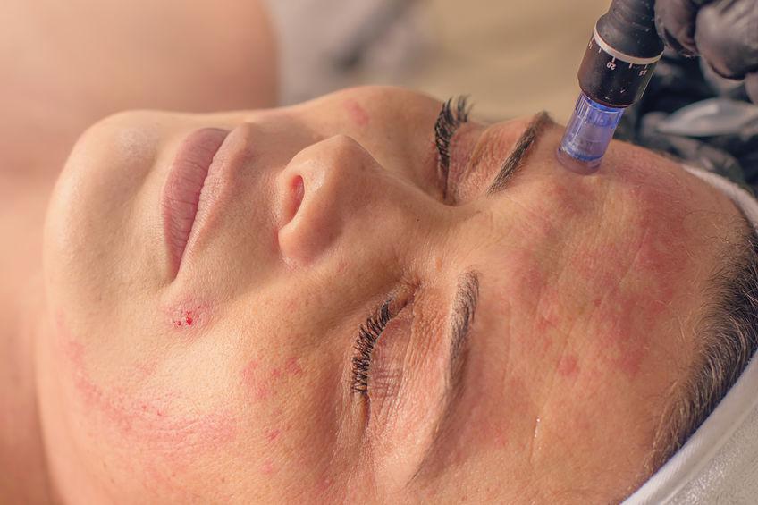 Microneedling for Acne Scars